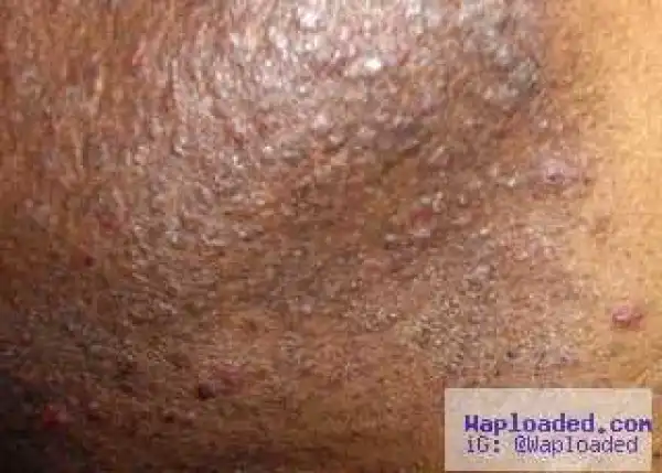 See The 6 Ways Of Preventing Razor Bumps